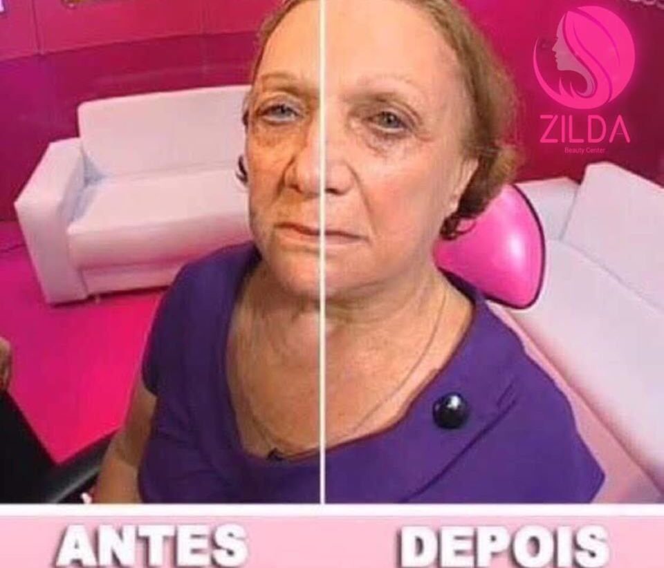 Vale Botox para a Noiva